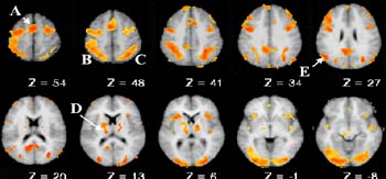 Sophisticated brain imaging reveals that several brain regions can become overactivated when people with Tourette Syndrome perform tasks related to memory.