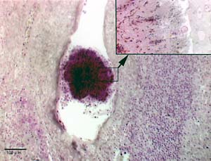 Magnified image of an infected tonsil