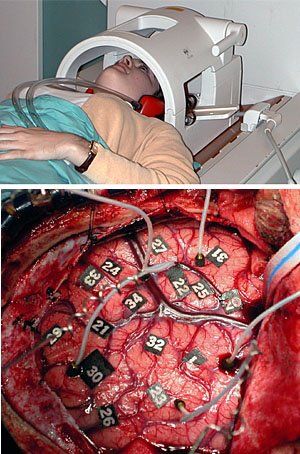 Improved techniques for the mapping of the brain's language areas using functional magnetic resonance imaging (top) may replace much more invasive pre-surgery mapping techniques.