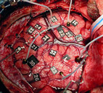 Improved imaging of brain's language areas may replace more invasive pre-surgery mapping techniques, such as the electrocortical stimulation method shown here.