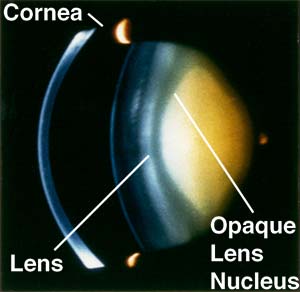 Human nuclear cataract (as seen through a slit lamp)