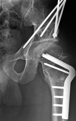 An X-ray of Christopher Mackey's hip following osteotomy surgery to correct hip dysplasia.