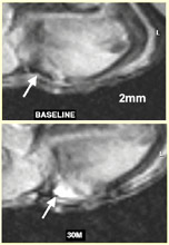 The top image shows an MRI of a melanoma tumor without nanoparticles. The bottom one shows the same tumor lighted up by nanoparticles.