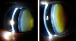 Left: This eye of a 72-year-old woman shows normal yellowing of the lens due to age-related nuclear sclerotic cataract. Right: The same woman's other eye shows opacification due to more severe nuclear sclerotic cataract two years after vitrectomy.