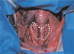 A dotted line indicates the former position of the thyroid in this child.