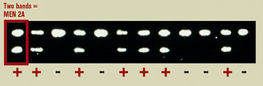 Two markers on the test blot reveal cancer risk. Early removal of the thyroid gland can prevent cancer later in life.