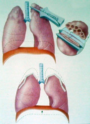 Lung volume reduction surgery showing the stapler and the typical location of resection of the lung