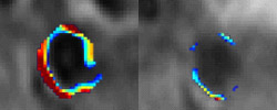 These before (left) and after pictures show the effects of fumagillin-laden nanoparticles which inhibit the growth of plaque-feeding microvessels in rabbit aorta.