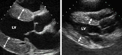 Echocardiograms show that the thickness of left ventricular (LV) walls in the hypertrophied heart (left) are nearly twice that of the normal heart.