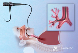 A bronchoscope delivers thermal energy to airways during a bronchial thermoplasty treatment.