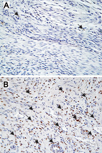 At 28 days after rotator cuff repair, the images indicate increased cell proliferation in the saline solution group (B) as compared to the nicotine group (A). Arrows point to new cells that stain brown because they contain a substance called proliferatin