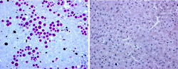 The large globules in the liver cells on the left are characteristic of alpha-1-antitrypsin deficiency. The image on the right shows normal liver cells.