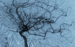 An angiogram, or X-ray image of blood vessels