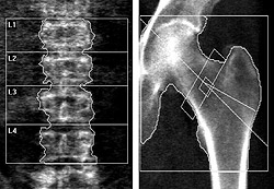 DXA scans of a male patient with osteoporosis