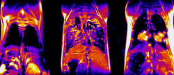 The MRI images of mouse lungs above show, from left, healthy lungs, lungs with fibrotic tissue and lungs with cancerous tumors.