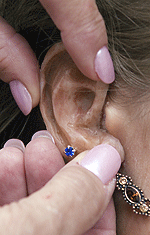 A closeup of Gravenhorst's prosthetic ear.