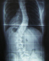 An X-ray of a case of scoliosis showing the abnormal curvature of the spine.