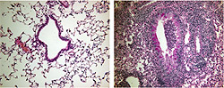 Normal lung air passage (left) and asthmatic lung air passage after viral infection