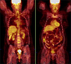 In these PET images, a cervical tumor glows brightly before therapy (left), but is no longer visible after therapy.