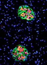 With a key protein disabled, a pair of kidney filtering units can't keep antibodies, which are red in this image, from building up in the filter. Scientists now think inability to keep these filters clear may be an important contributor to kidney damage.