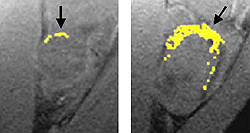 A tumor treated with fumagillin nanoparticles (left) is smaller than an untreated tumor (right.) Nanoparticles containing an image enhancing metal (yellow) show that the treated tumor has much less blood vessel growth than the untreated tumor.