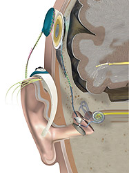 Cochlear implant