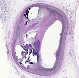 artery plaque