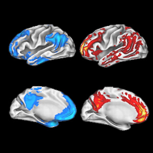 brain plaques