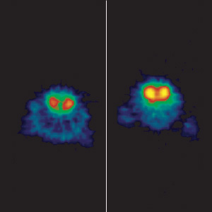 Dopamine scan