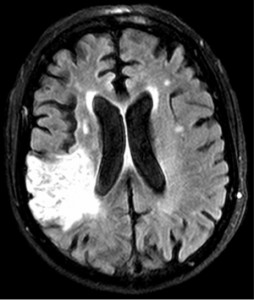 Stroke brain scan