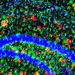 Brain plaques