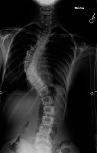 spine x-ray