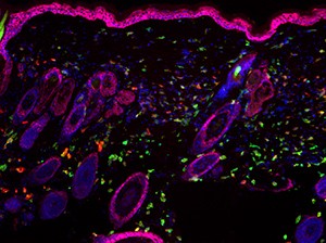 Immune cellls causing skin inflammation