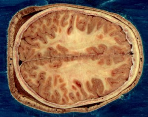 A new study of how stroke damages the brain has shown that it is more likely to harm the white matter inside the brain, visible above in an image from the Visual Human Project at the National Library of Medicine. The insight may help scientists develop new strategies to help patients recover after stroke.