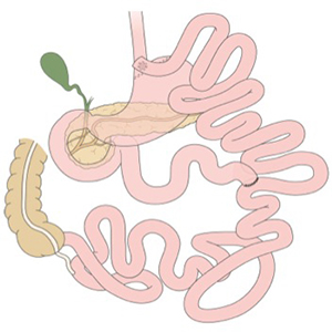 A small study of women at Washington University School of Medicine in St. Louis indicates that gastric bypass surgery changes how alcohol is metabolized after surgery and can speed its delivery into the bloodstream, resulting in earlier and higher peaks in blood-alcohol levels.