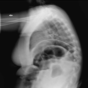 This blurred X-ray illustrates how movement can affect X-ray images and require that further images be taken. A new imaging approach that incorporates Xbox gaming technology alerts X-ray technicians to factors that could compromise image quality, thus cutting down on the number of X-rays needed and, consequently, patient exposure to radiation. (Credit: Steven Don)