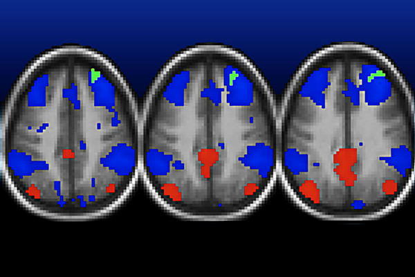 Poverty linked to childhood depression, changes in brain connectivity