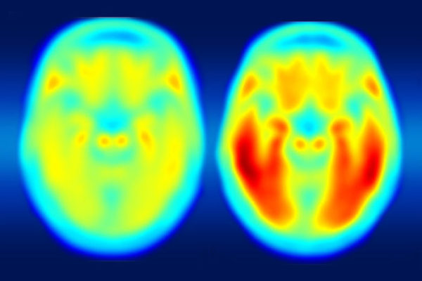 Brain imaging links Alzheimer’s decline to tau protein