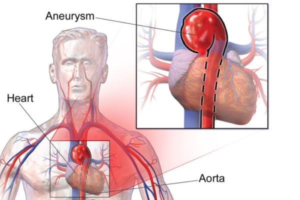 Genetic error that increases risk of aortic rupture identified