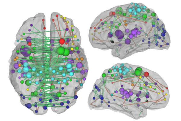 Measuring damage to brain networks may aid stroke treatment, predict recovery