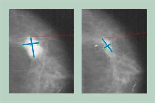 New study shows breast tumors evolve in response to hormone therapy