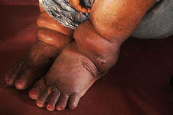 $8 million grant aids effort to eliminate elephantiasis