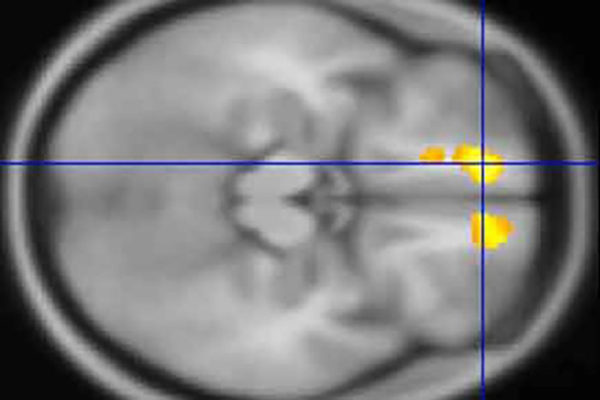 Brain scans of children with Tourette’s offer clues to disorder