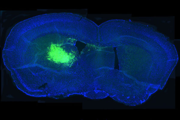 Gene linked to metabolism drives deadly brain cancer