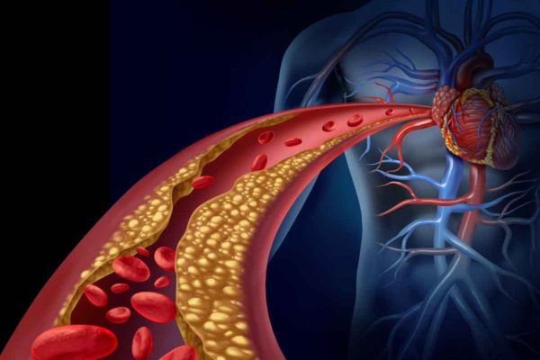 Study reveals ways to improve outcomes, reduce costs for angioplasty