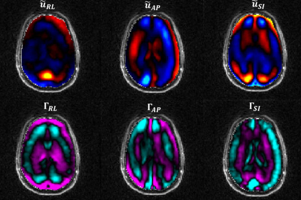 Studying the brain’s suspension system in TBIs