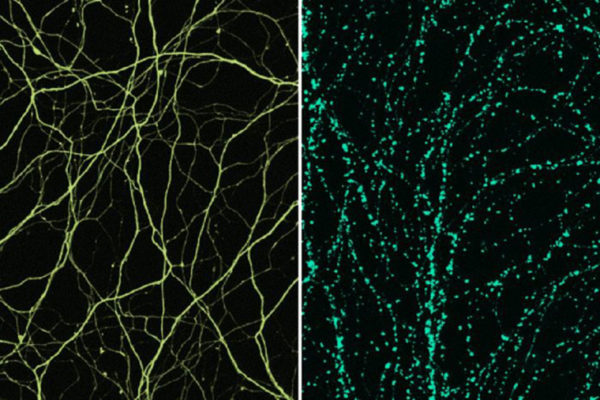 Surprising culprit in nerve cell damage identified