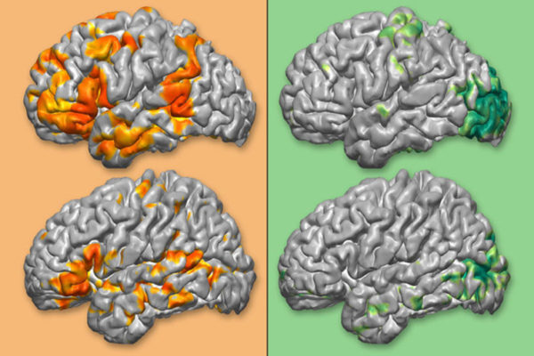 $3.6 million to fund personalized 3-D brain maps to guide neurosurgeries