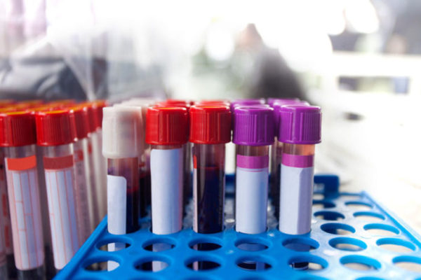 Blood test IDs key Alzheimer’s marker