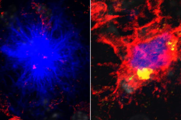 Alzheimer’s risk linked to energy shortage in brain’s immune cells